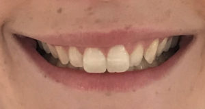 Behandlung des Zahnfleischlächelns (gummy smile)